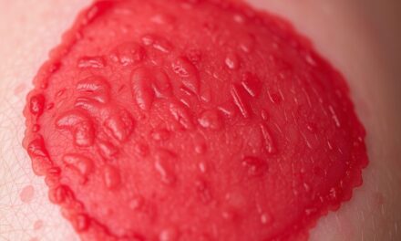 Sezonowe zaostrzenie rumienia: jak rozpoznać przyczyny i wprowadzić skuteczną pielęgnację